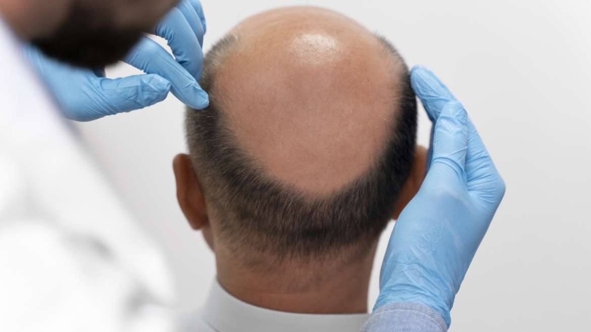 fue hair transplant
