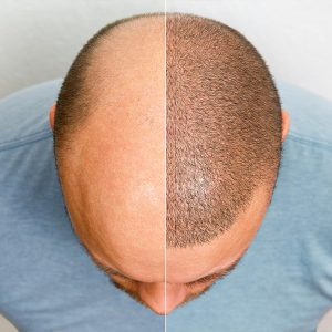 Ensuring Success: The Value of Following Up After Your Hair Transplant