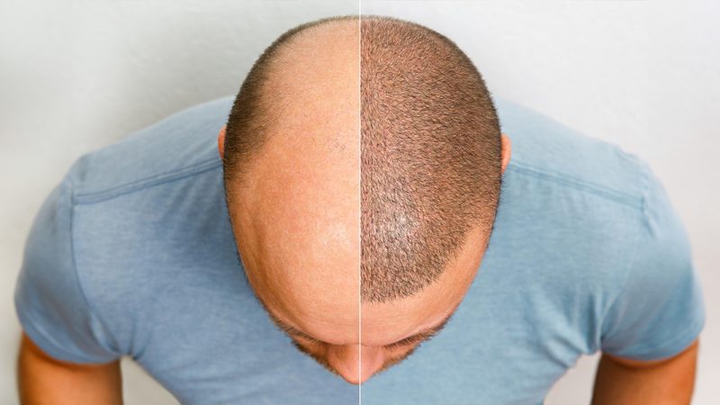 Ensuring Success: The Value of Following Up After Your Hair Transplant