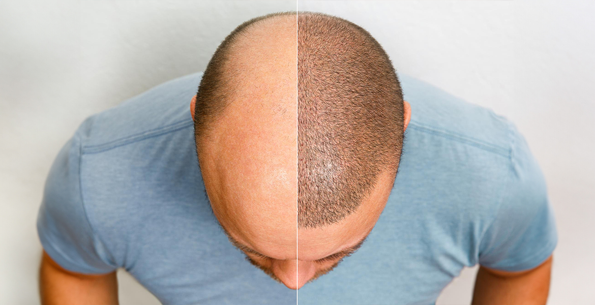 Ensuring Success: The Value of Following Up After Your Hair Transplant